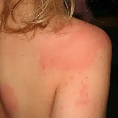 allergie chat peau rougeurs